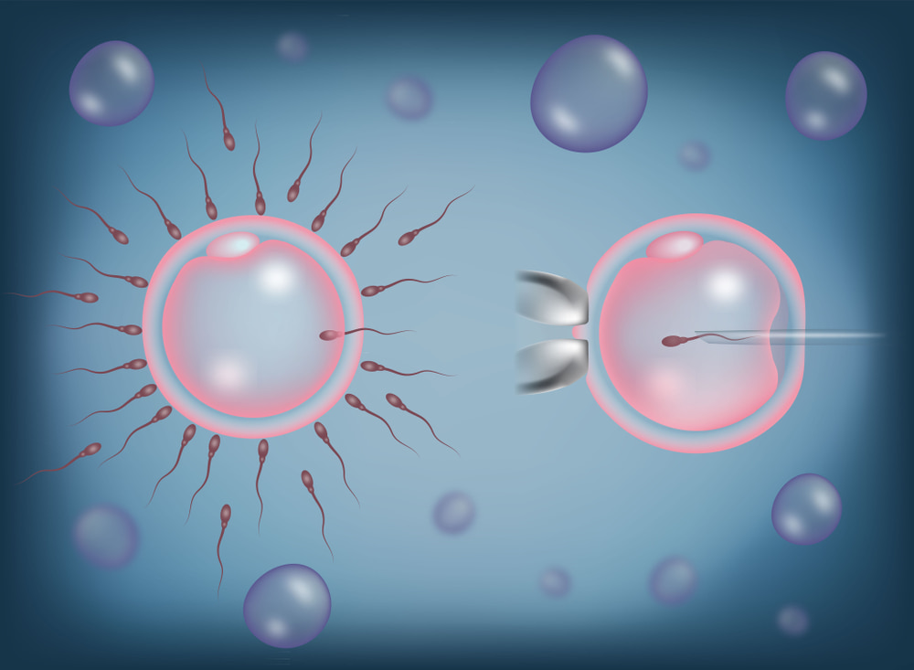 FIV e ICSI: Qual a diferença e qual técnica escolher?